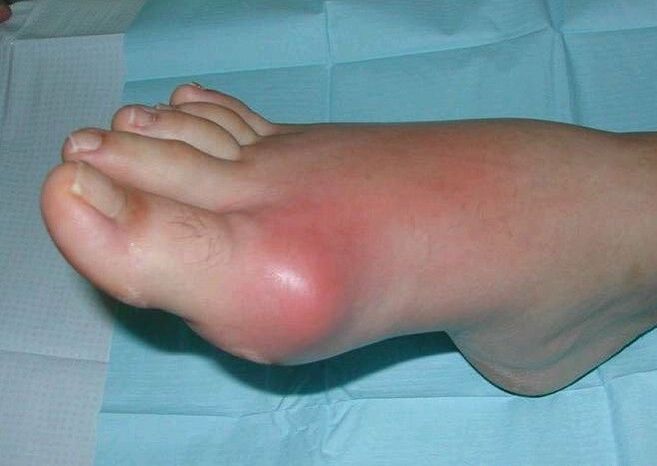 Klinický obraz artritídy nohy - opuch a zápal