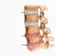 Osteochondróza