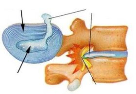 zničenie vláknitého prstenca pri cervikálnej osteochondróze