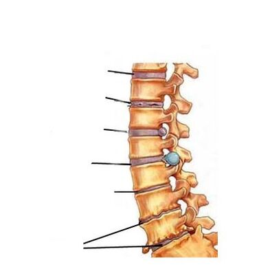 štádia vývoja osteochondrózy