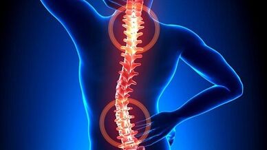 mechanizmus rozvoja osteochondrózy