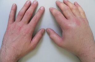 artralgia ako príčina bolesti kĺbov prstov