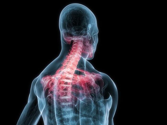 osteochondróza krčnej chrbtice je modifikáciou medzistavcových chrupavkových platničiek