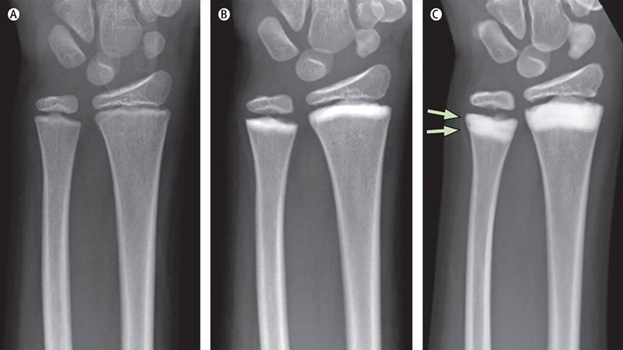 röntgenový snímok pravého zápästia