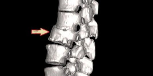 patológia chrbtice ako príčina bolesti chrbta