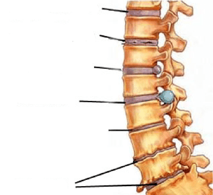 štádia vývoja osteochondrózy chrbtice