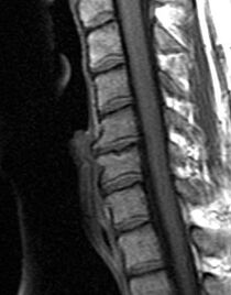 rádiografia hrudnej chrbtice
