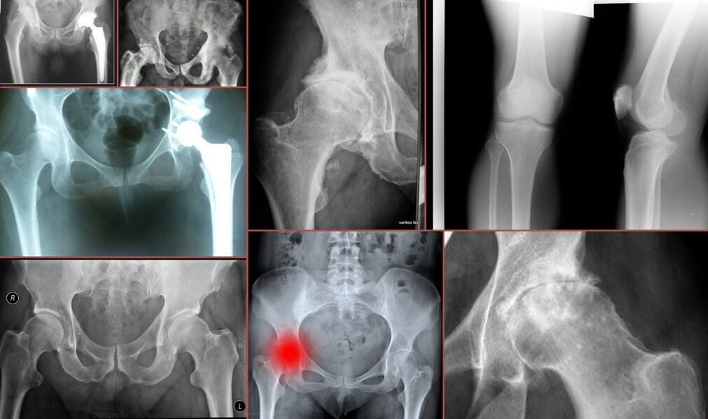 Röntgenové vyšetrenie bolesti bedrového kĺbu
