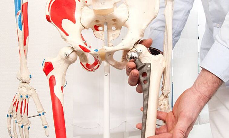 endoprotéza bedrového kĺbu proti bolesti