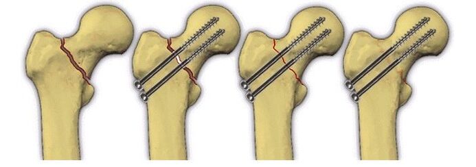 fixácia telesa kosti čapmi pri bolestiach v bedrovom kĺbe