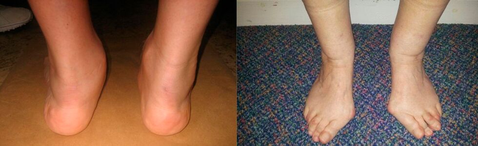 Artróza palca na nohe a deformujúca artróza členka