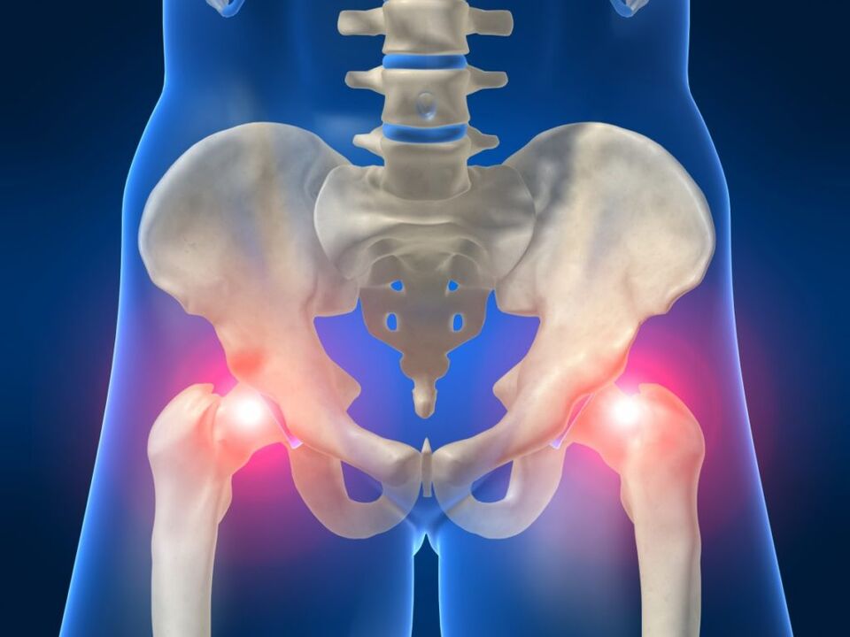 Pri ankylozujúcej spondylitíde je bilaterálna bolesť v bedrovom kĺbe rušivá