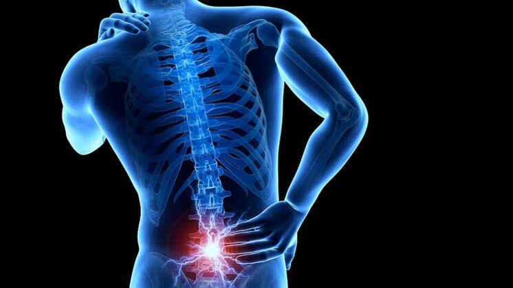 bolesť chrbta s bedrovou osteochondrózou