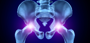 artróza bedrového kĺbu kĺbu